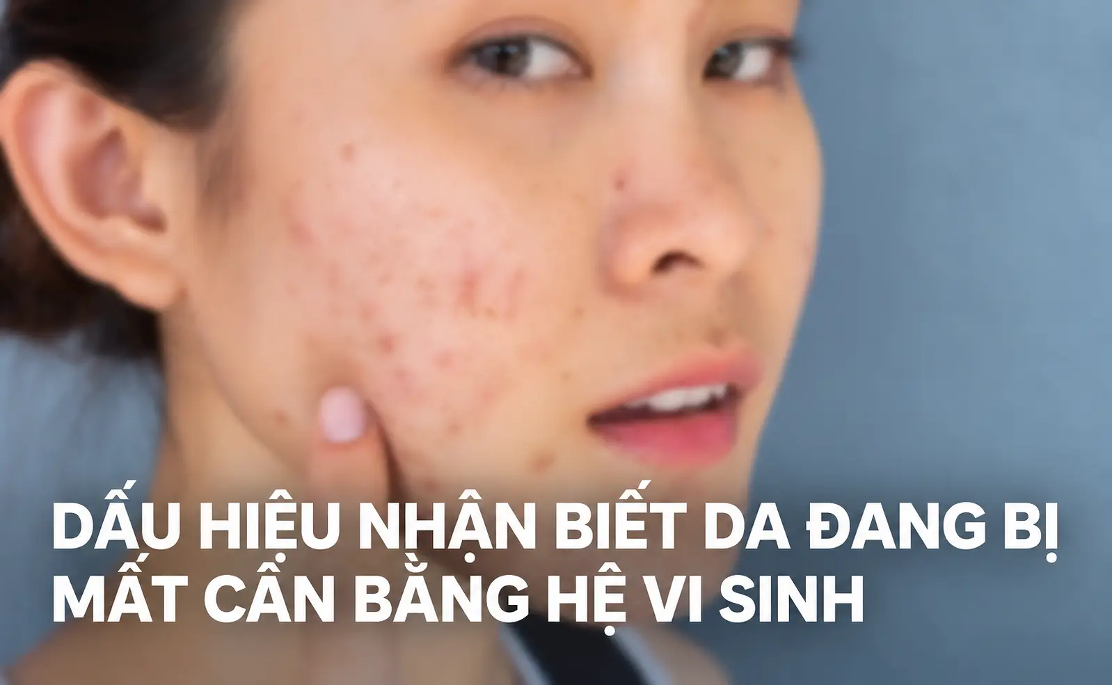 Dấu hiệu nhận biết da đang bị mất cân bằng hệ vi sinh