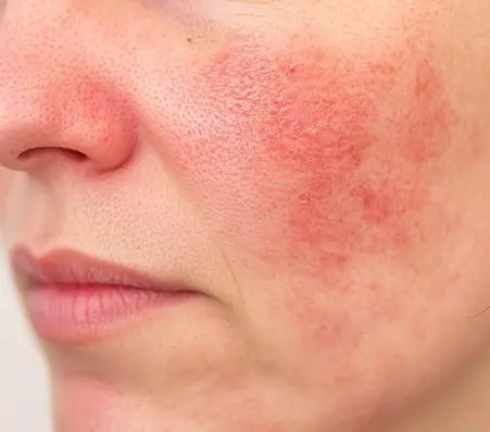 Da nhạy cảm dễ kích ứng