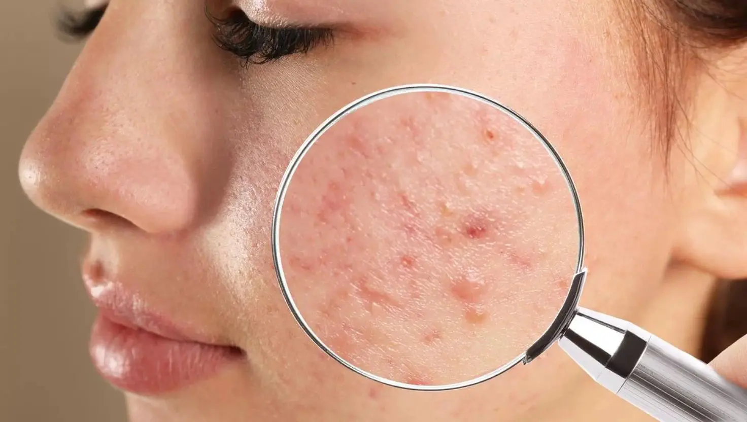 Dấu hiệu da mất cân bằng hệ vi sinh